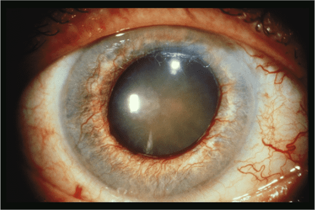 Закрытоугольная глаукома
