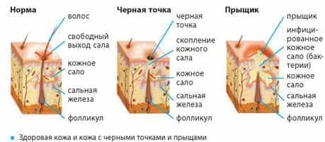 Появление акне и розовых прыщей розацев