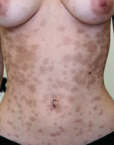 Аллергические болезни кожи