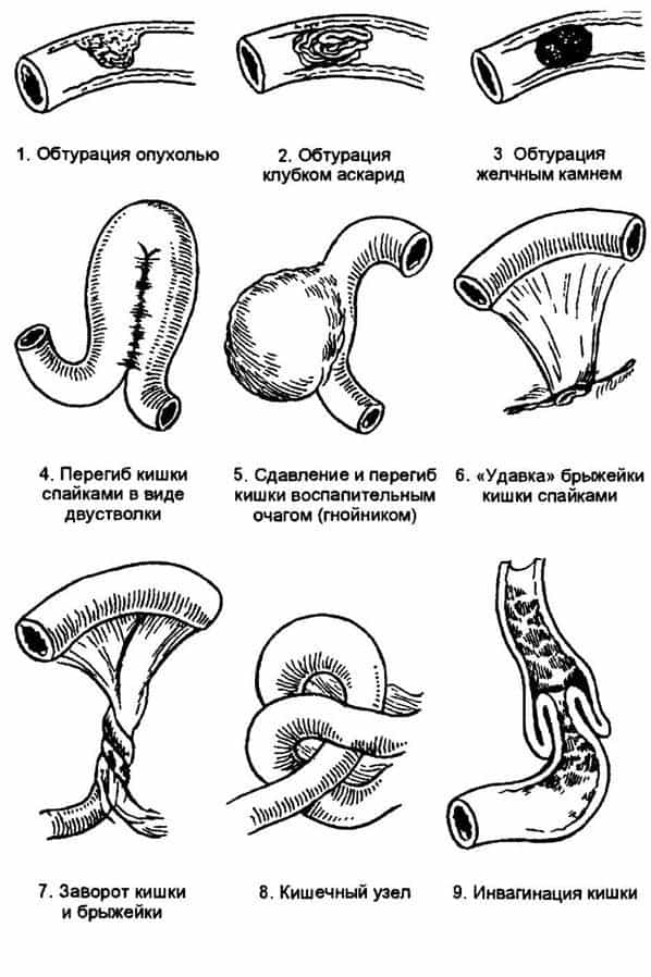 Операция Кишечная Непроходимость Диета