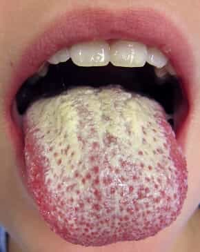 Кандидоз слизистой полости рта
