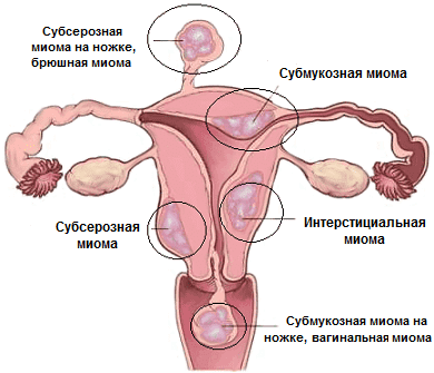 Миома И Лишний Вес Форум