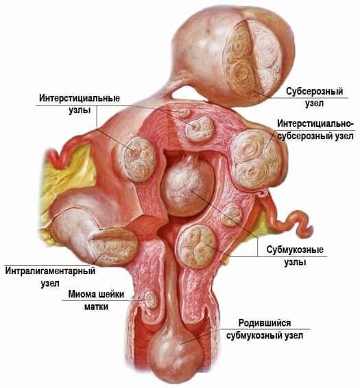 Фото матки с миомой