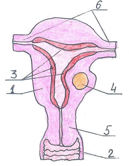 Межмышечная миома тела матки фото