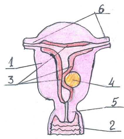 Подслизистая (субмукозная) миома тела матки фото