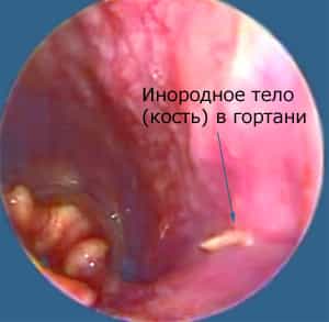 Инородные тела глотки. Кость в гортани.