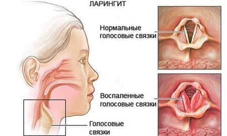 Ларингит острый (ложный круп)