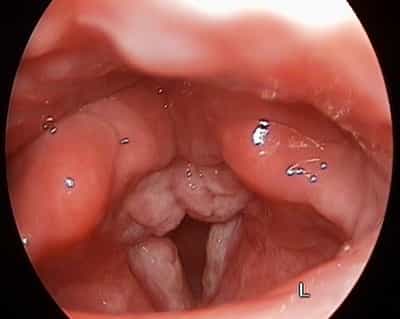 Ларингит хронический
