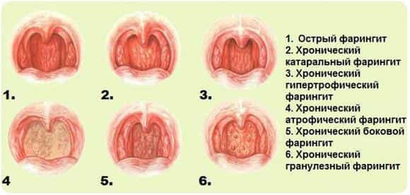 Фарингит