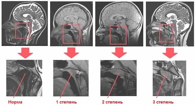 Стадии развития аденоидов