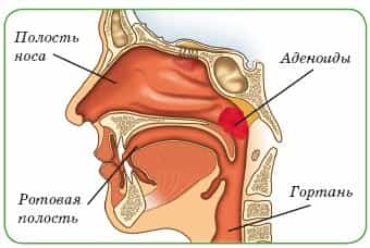 Аденоиды