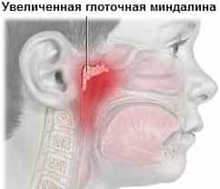 Увеличенная носоглоточная миндалина