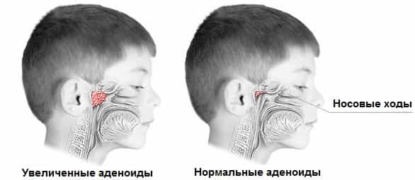 Лечение аденоидов