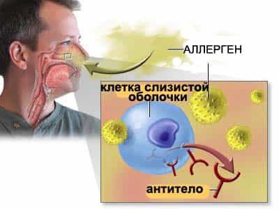 Аллергические синусопатии