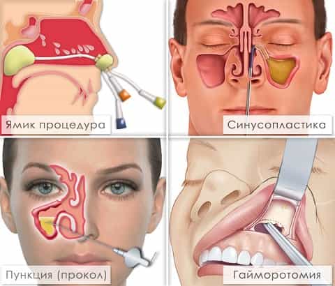 Хирургическое лечение гайморита