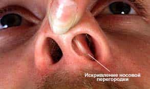 Гематома и абсцесс носовой перегородки