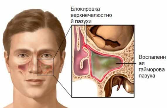 Аллергические синусопатии