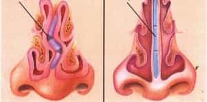 Искривление носовой перегородки