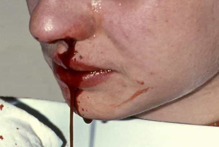 Кровотечение носовое