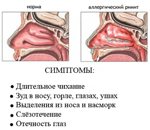 Насморк (аллергический и вазомоторный)