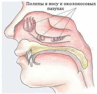 Полипы носа