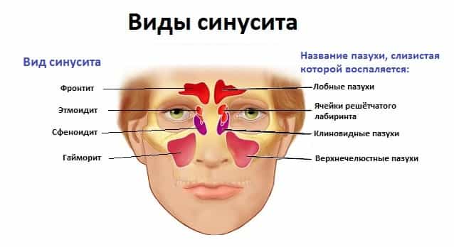 Синусит