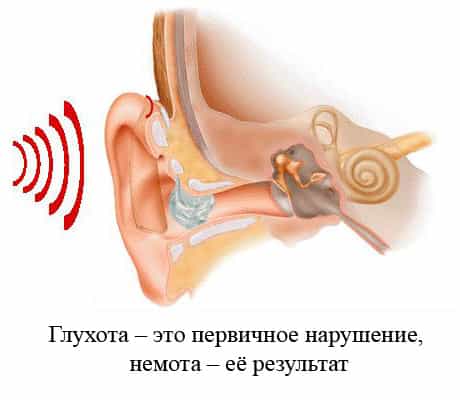 Глухонемота