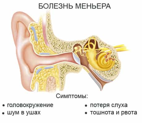 Меньера болезнь