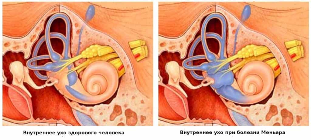 Меньера болезнь