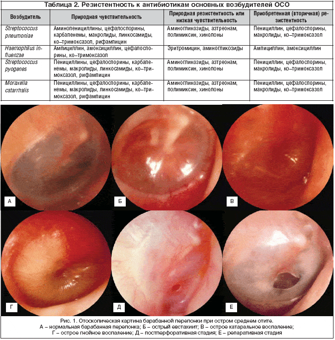 Отит острый гнойный средний (перфоративный)