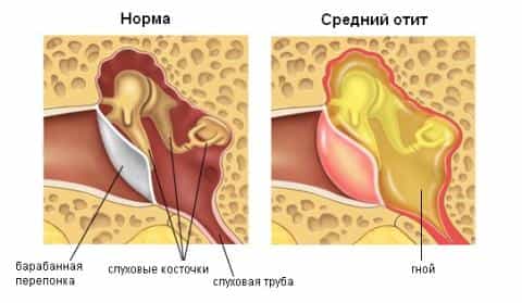 Отит острый гнойный средний (перфоративный)