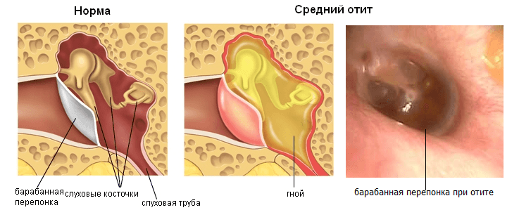 Отит средний гнойный хронический