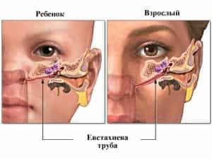 Отит катаральный средний острый