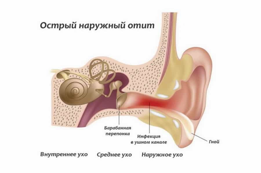 Отит острый наружный разлитой