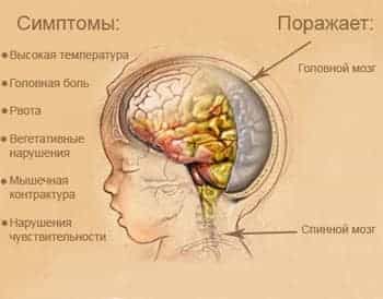 Менингит у ребенка