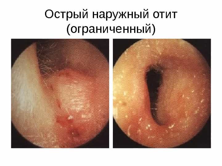 Отит острый наружный ограниченный