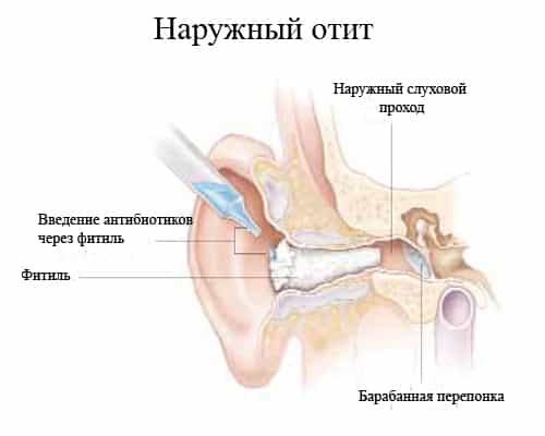 Отит острый наружный разлитой