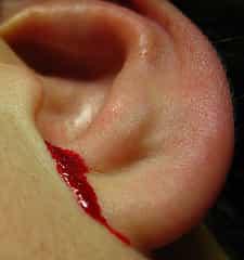 Кровотечения из уха