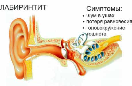 Лабиринтит