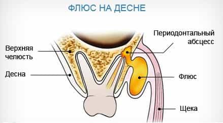 Абсцесс зуба