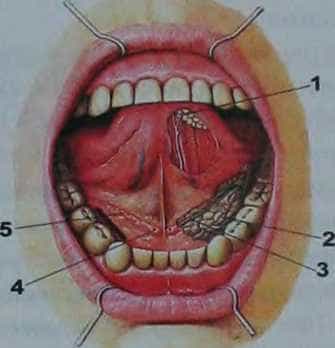 Абсцесс дна полости рта