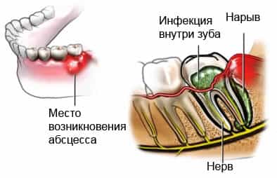 Абсцесс зуба