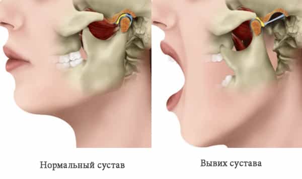 Вывих челюсти