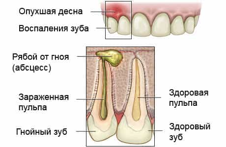 Абсцесс зуба