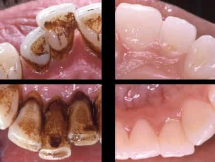 Зубной камень