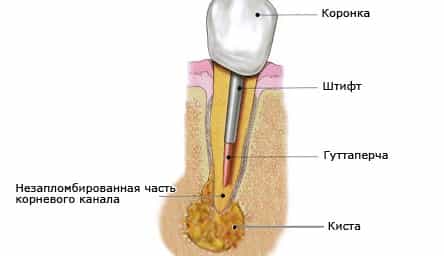 киста зуба