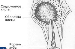 Киста челюсти