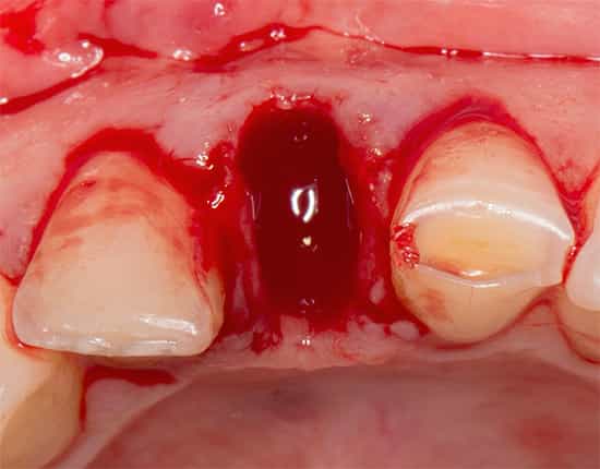 Кровотечение после операции удаления зуба