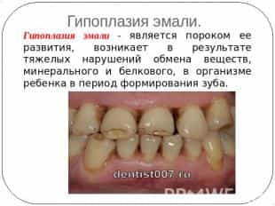 Некариозное поражение зубов