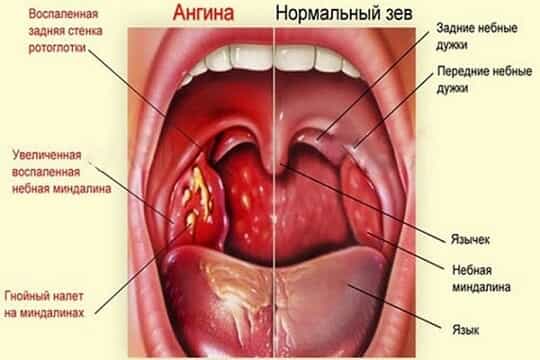 Лечение ангины